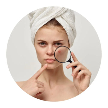 Acne Concern